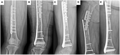 Frozen inactivated autograft replantation for bone and soft tissue sarcomas